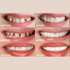 1+1 Gratis | SnapSmiles™ Aufsteckprothesen