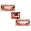 1+1 Gratis | SnapSmiles™ Aufsteckprothesen
